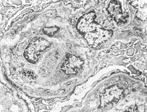 type I membranoproliferative glomerulonephritis